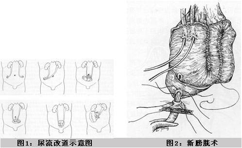 膀胱尿道后角示意图图片